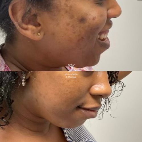 Before and after skin regimen at LYFE MEDSPA Indianapolis — reduced dark spots and acne marks