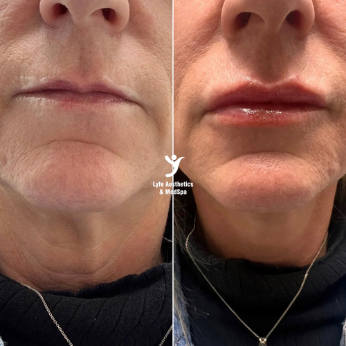 Before and after lip filler at LYFE MEDSPA in Indianapolis — restored volume in mature lips