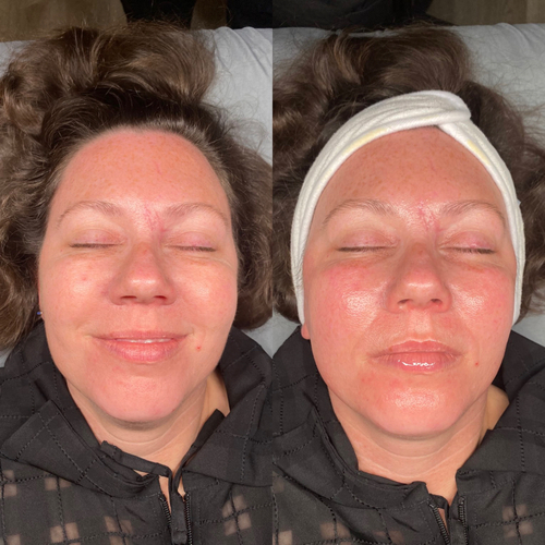 Before and after dermaplane facial at LYFE MEDSPA Indianapolis — smoother, brighter skin