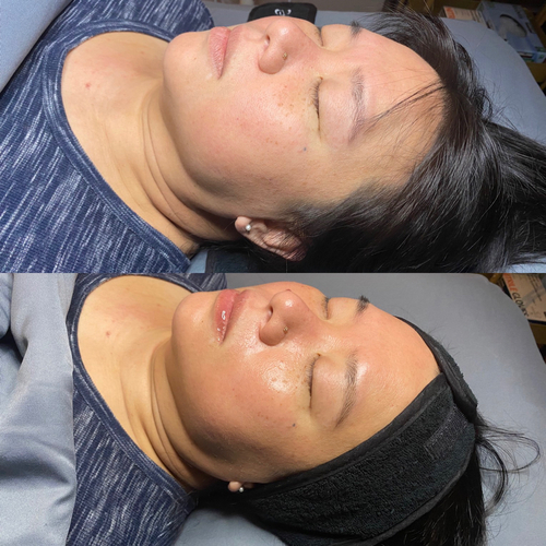 Before and after customized facial at LYFE MEDSPA Indianapolis — hydrated, glowing skin
