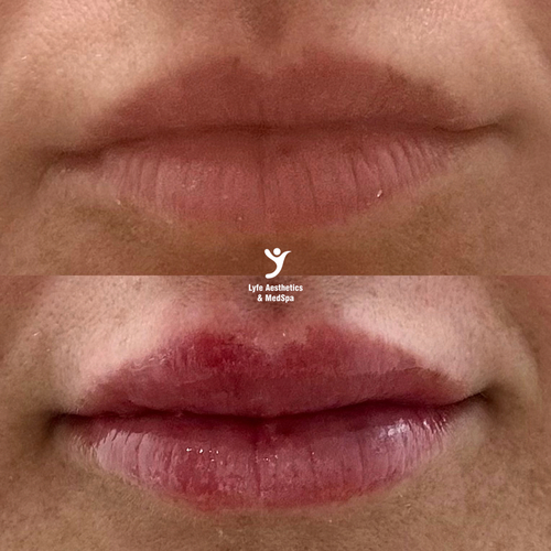 Before and after lip filler at LYFE MEDSPA Indianapolis — fuller, defined lip border