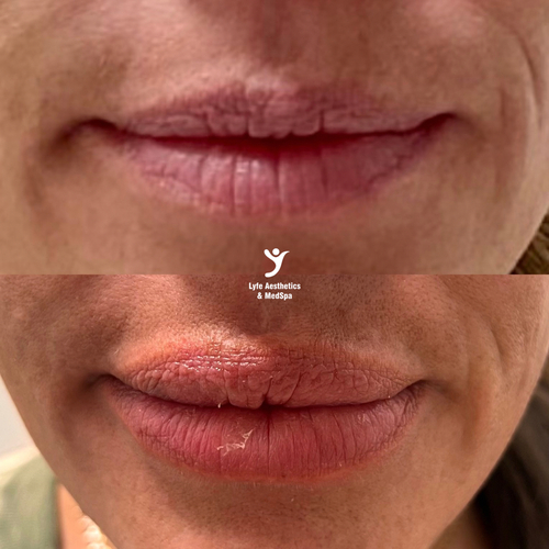 Before and after lip filler at LYFE MEDSPA Indianapolis — subtle hydration and definition